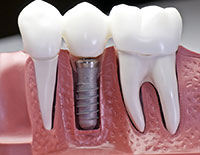 Dental Implants- Dentist In Fresno, CA | Curt P. Posey, DDS, Inc.